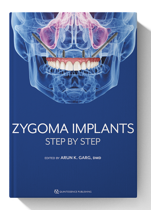 Zygoma Implants Step by Step 1st Edition