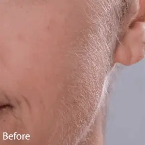 סכין גילוח לשערות פרווה אחרי ולפני