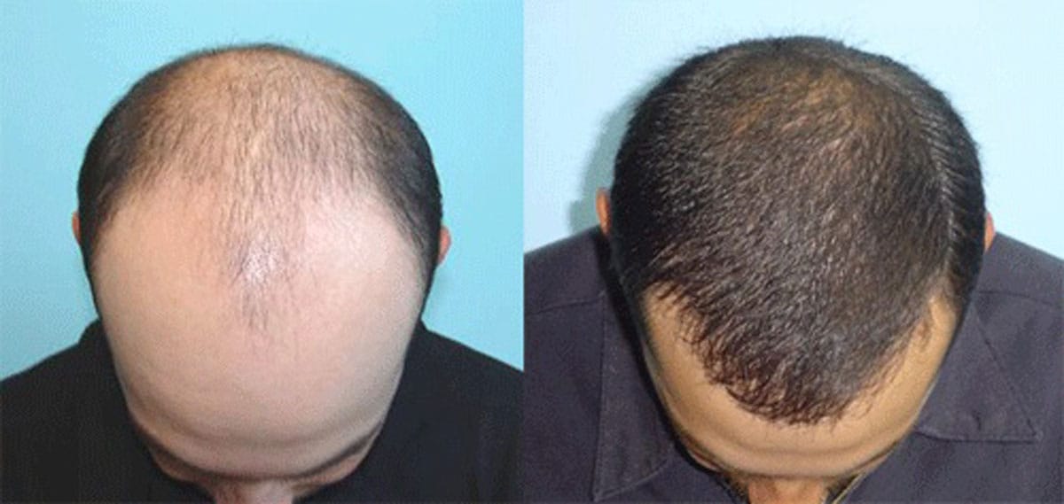 a1a6479f-fad9-476d-a446-f5d9ef8c4806.hair-grow-faster-before-after