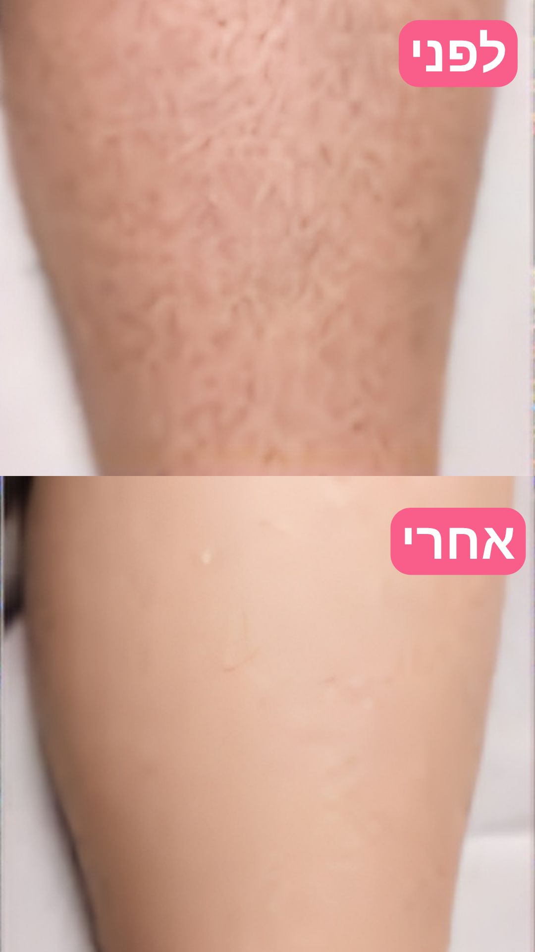 EpiLa, EpiLa.co.ul, ערכה להסרת שיער, הסרת שיער
