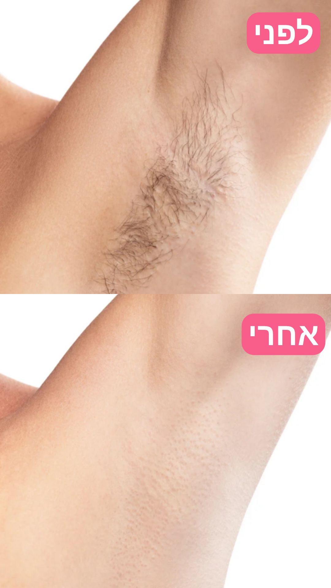 EpiLa, EpiLa.co.ul, ערכה להסרת שיער, הסרת שיער