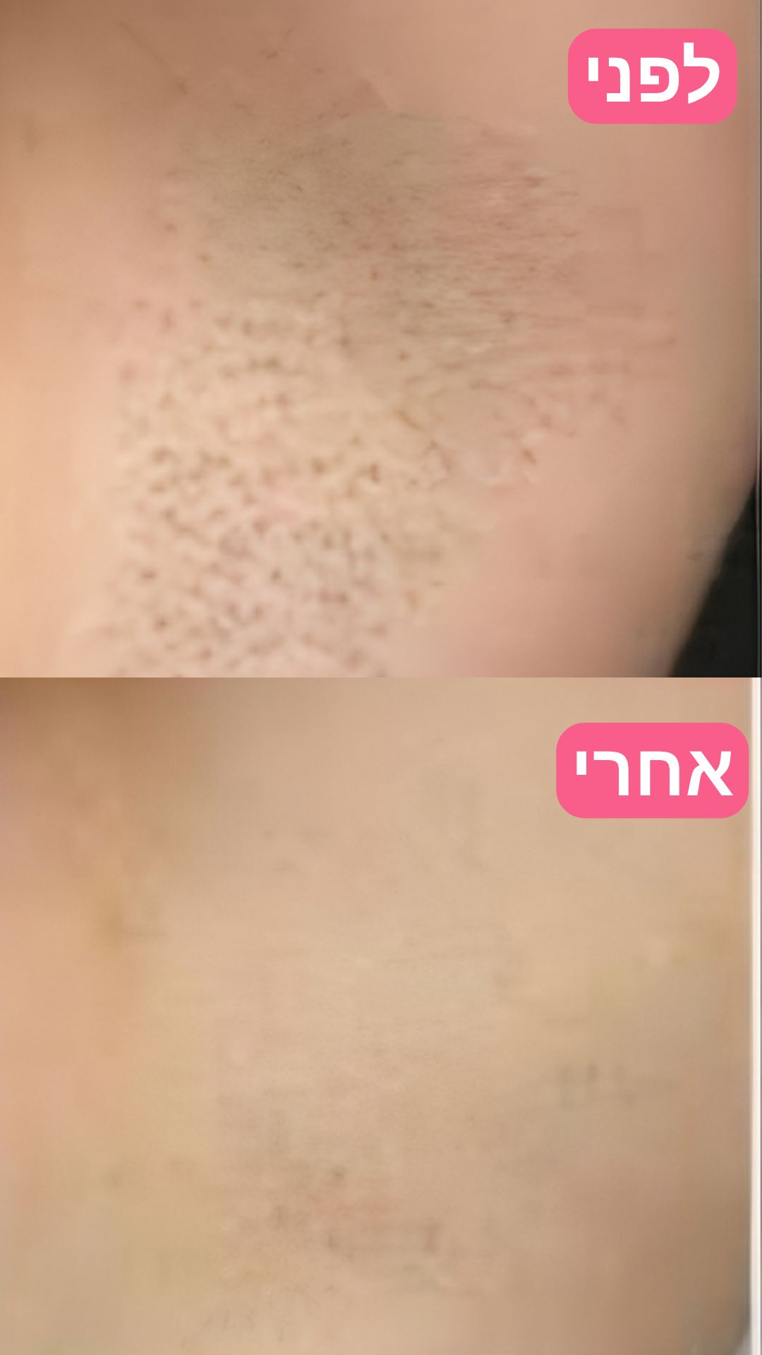 EpiLa, EpiLa.co.ul, ערכה להסרת שיער, הסרת שיער