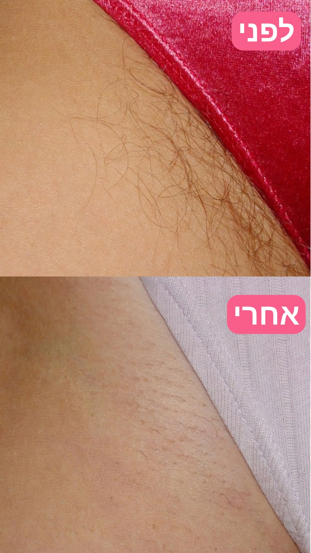 EpiLa, EpiLa.co.ul, ערכה להסרת שיער, הסרת שיער