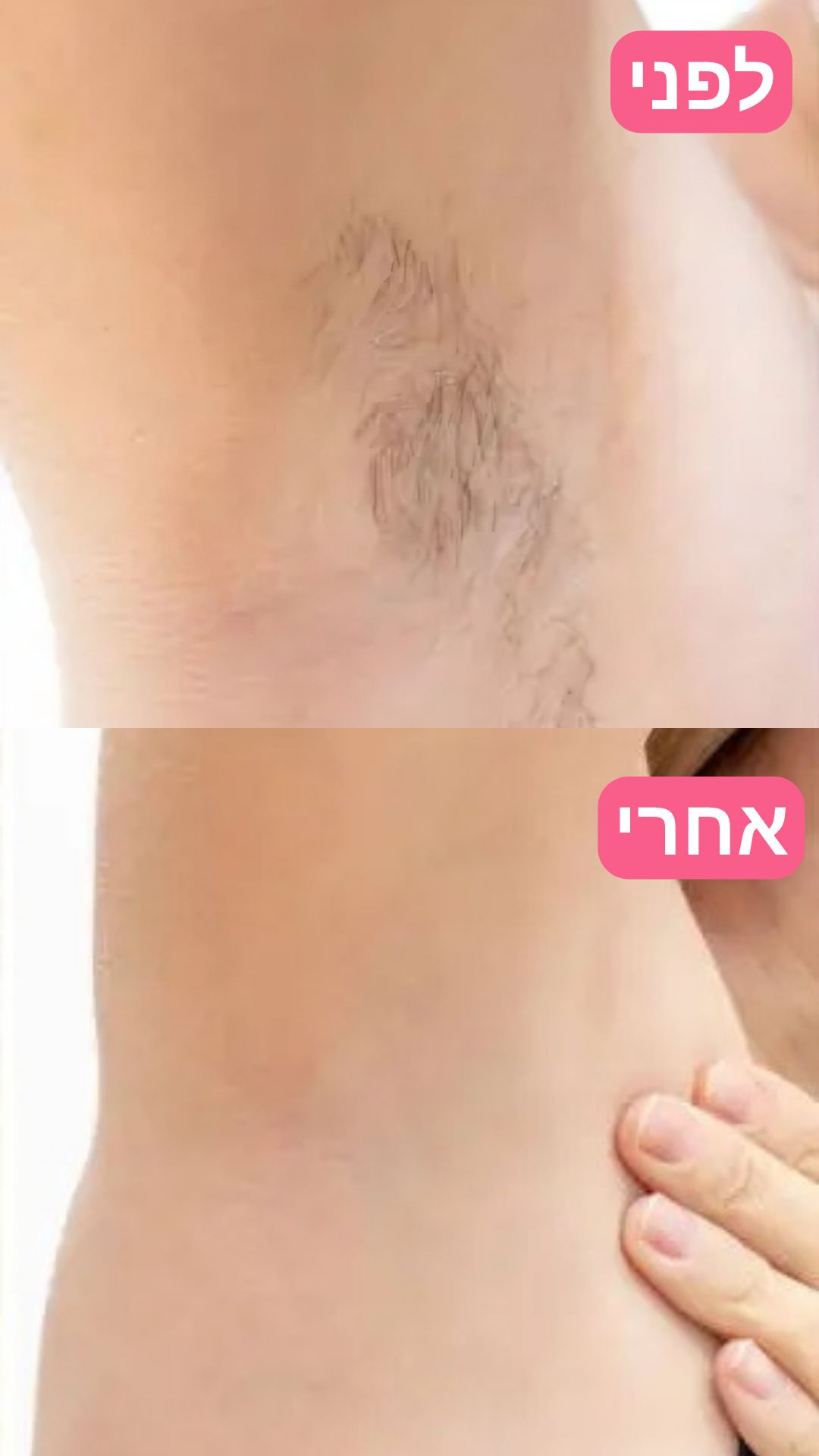 EpiLa, EpiLa.co.ul, ערכה להסרת שיער, הסרת שיער