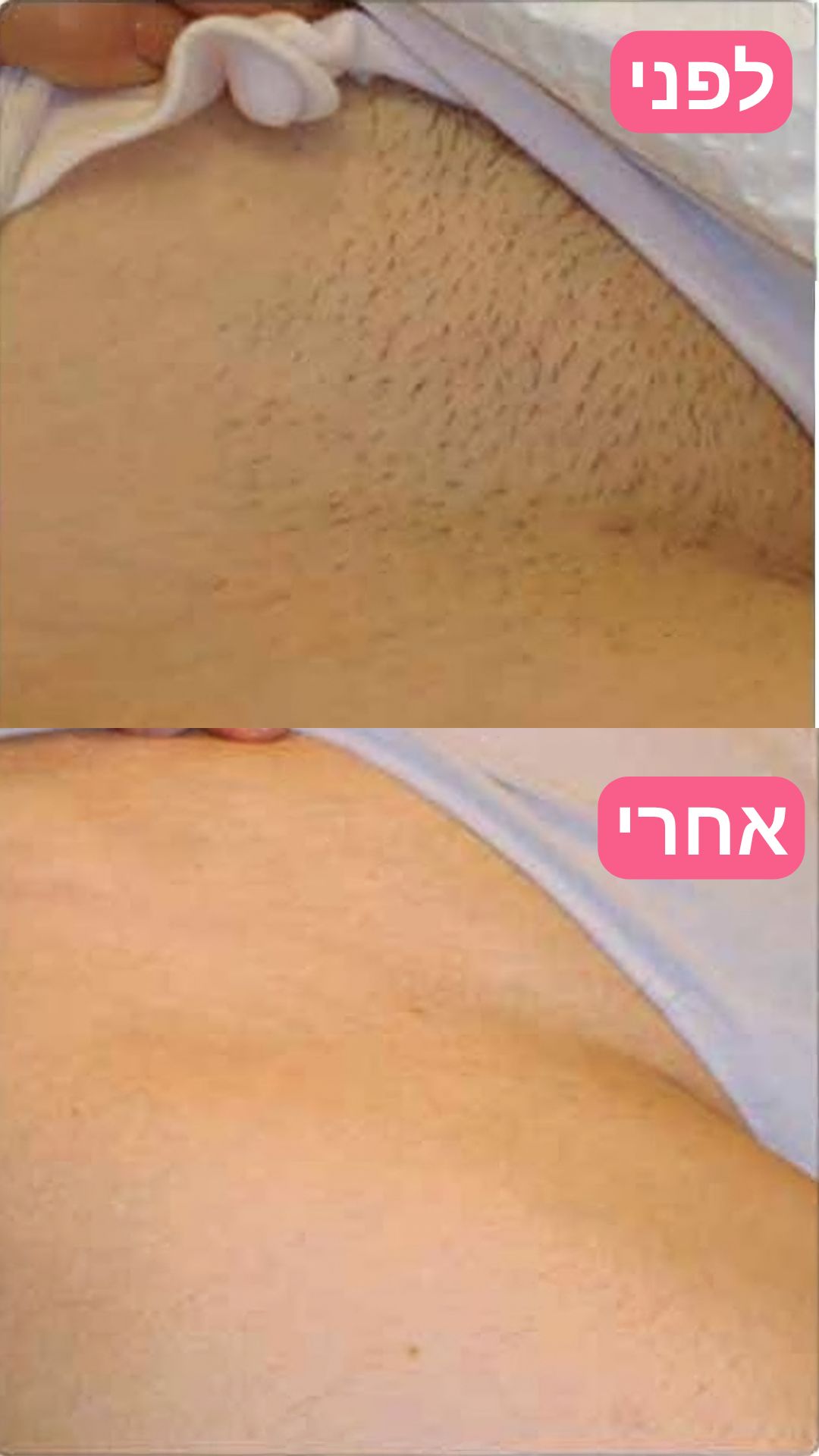 EpiLa, EpiLa.co.ul, ערכה להסרת שיער, הסרת שיער