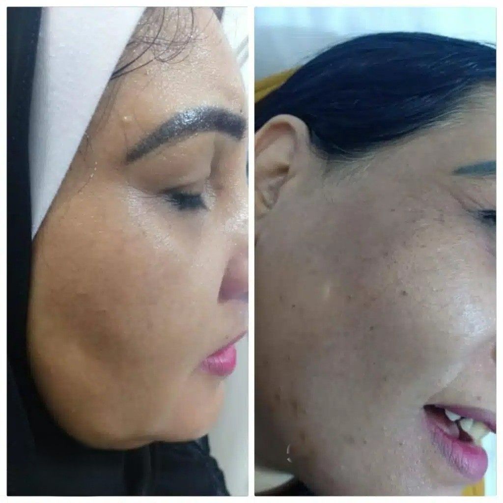 5bbb72ee-09ed-490d-8959-c94457782b14.imgi_67_تفتيح-وتوحيد-لون-البشرة-في-الغردقة-1024x1024